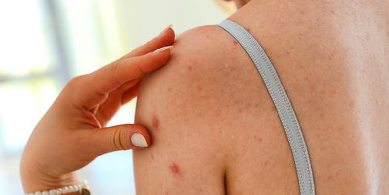 Akne në trup? – Kjo është zgjidhja – Ekonomia Online