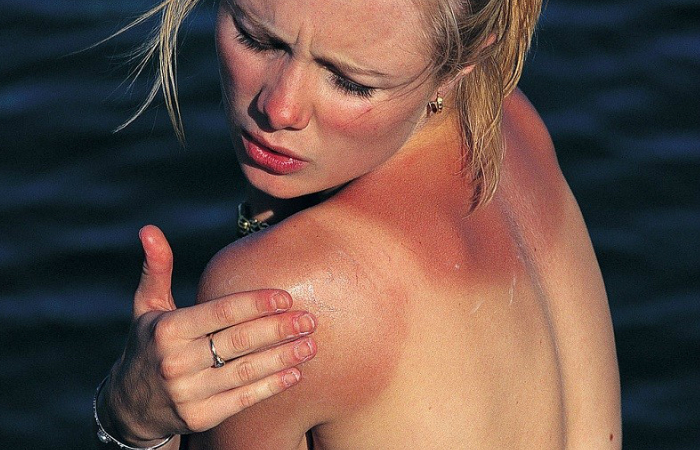 Ilaçi më i mirë për djegiet nga dielli gjindet në kuzhinën tuaj – Ekonomia Online