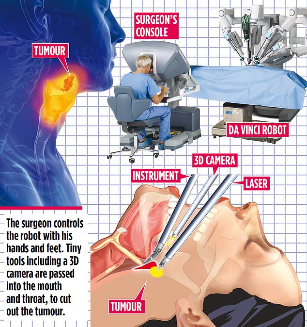 The 90minute operation is designed to dramatically reduce the need for gruelling radiotherapy and chemotherapy, which can leave patients unable to swallow and dependent on a feeding tube for life